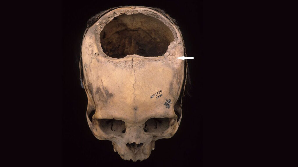 How the Incas Performed Skull Surgery More Successfully Than U.S. Civil War Doctors